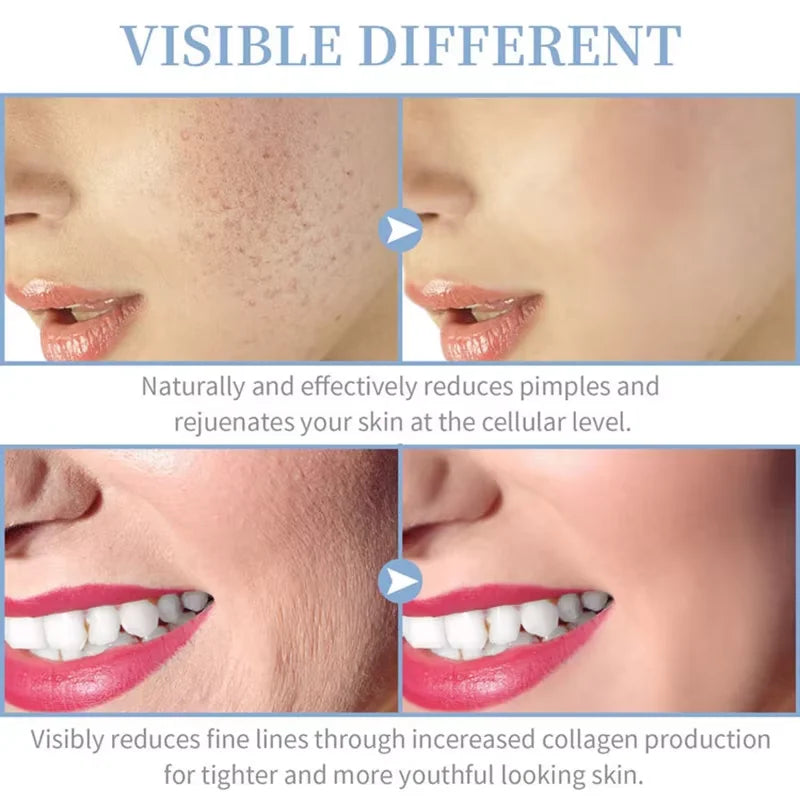 4-in-1 High Frequency Electrode Glass Tube Acne Skin Care Wand